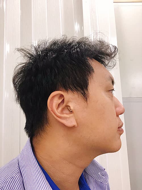 耳內式助聽器6SA2樣式示意圖