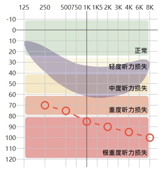 優劣耳聽損 聽力圖範例